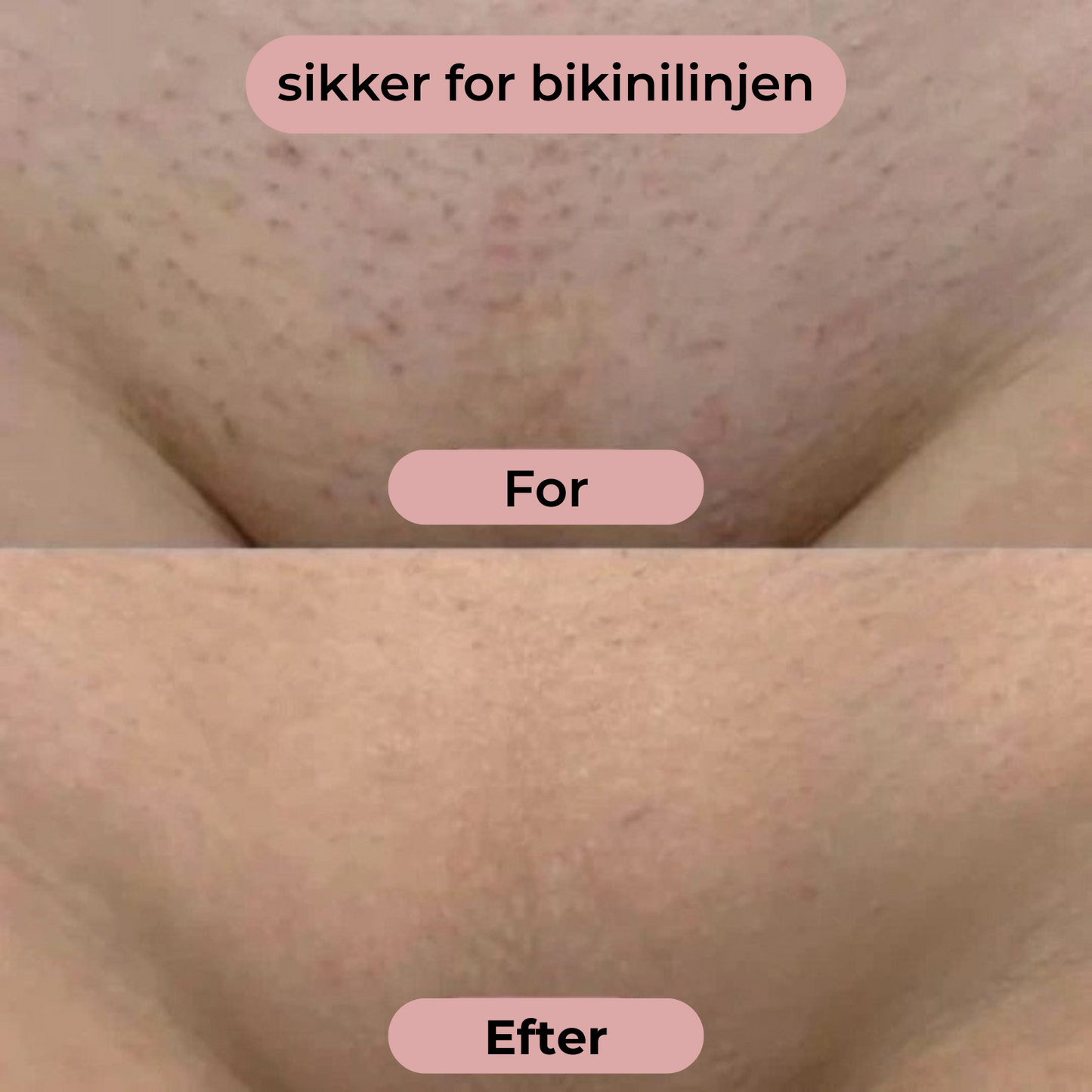 ShavePlus™ 2-i-1 Ladyshave  – Intim barbering uden irritation, snitsår eller stress