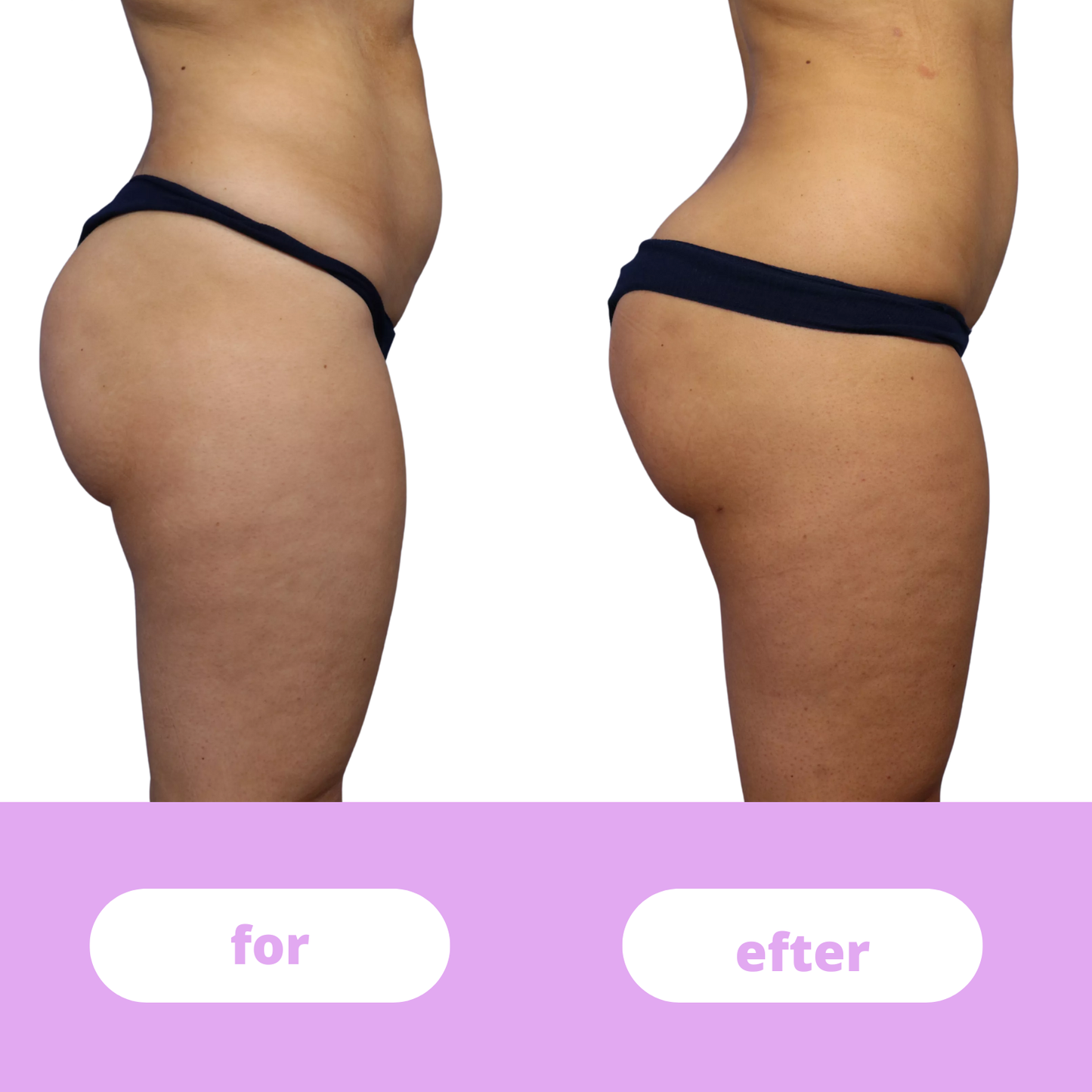 GluteMaster™ – Booty Trainer til fastere og stærkere balder